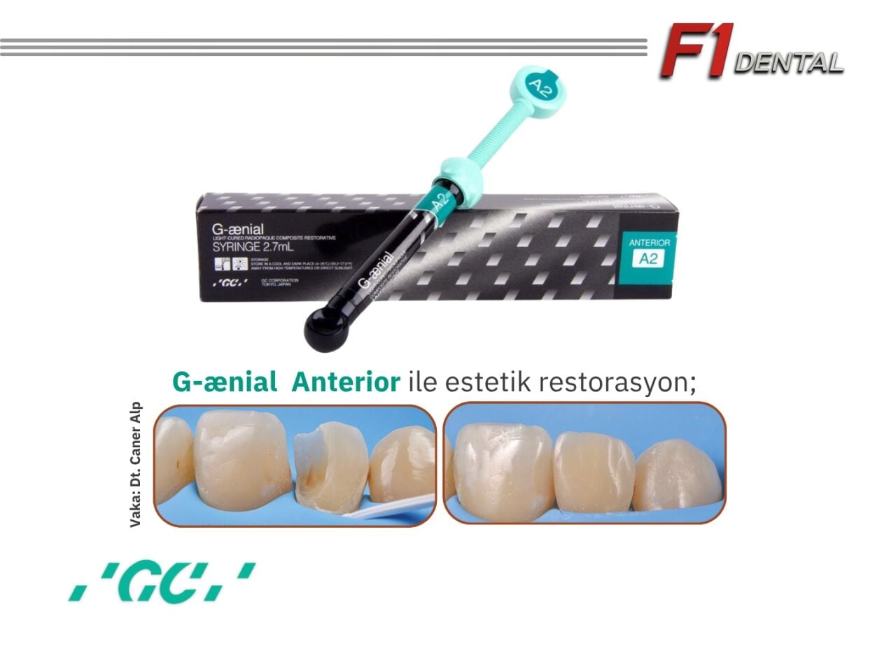 Diş Hekimliğinde Devrim: GC Ganial Universal Injectable ve everX Flow ile Estetik Kompozit Dolgu Çözümleri
