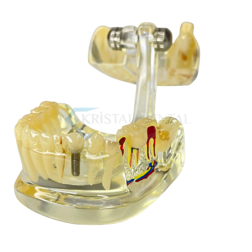 Şeffaf İmplant Model Diş