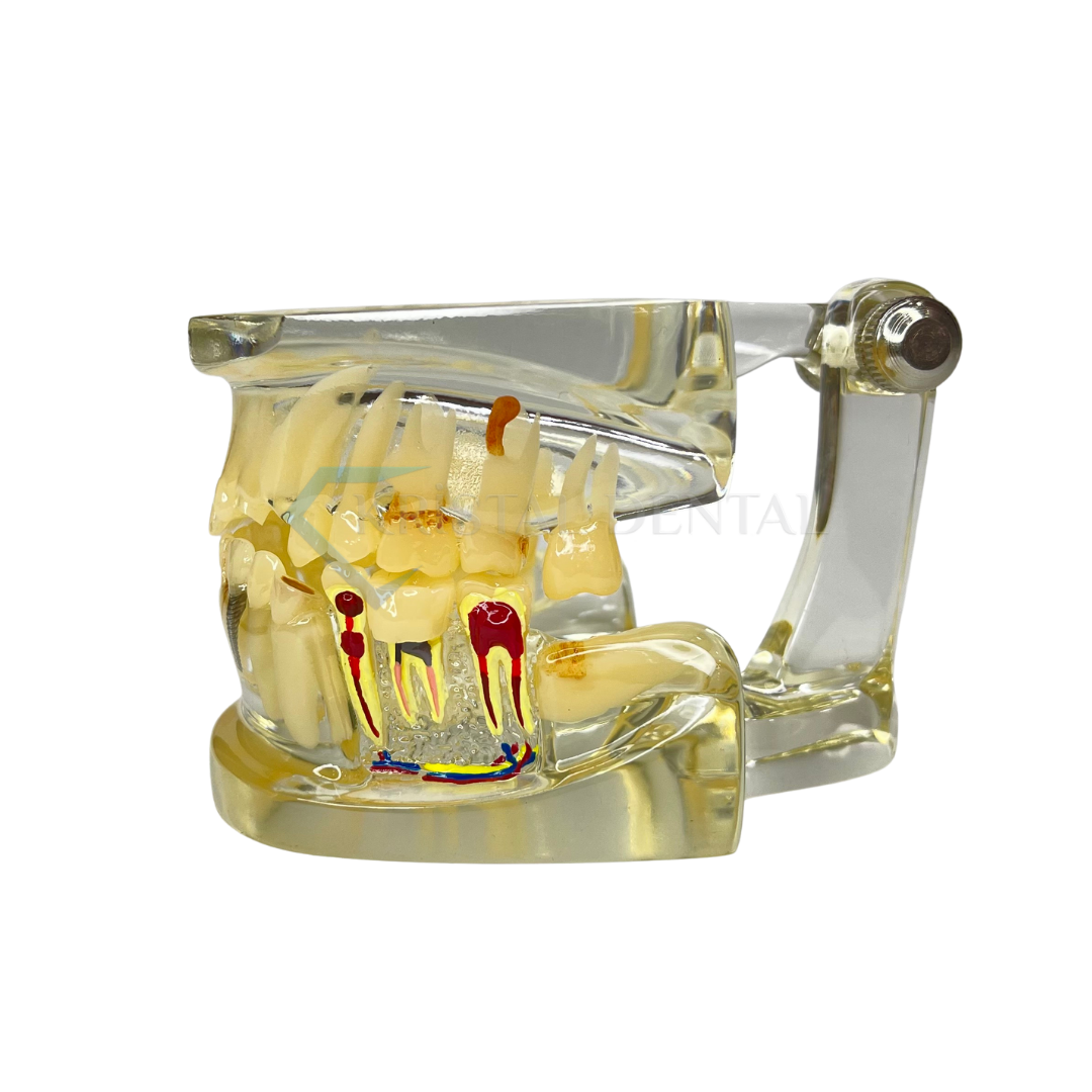 Şeffaf İmplant Model Diş