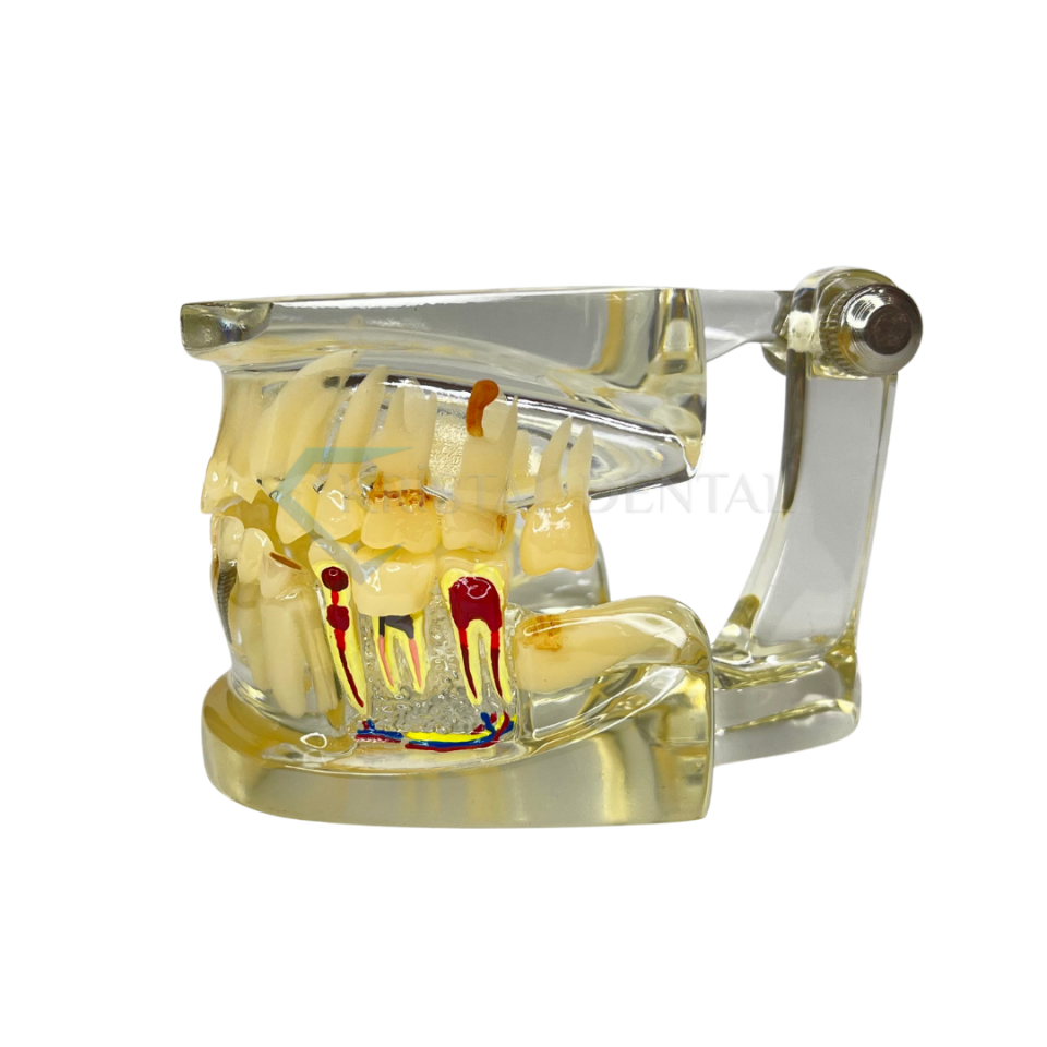 Şeffaf İmplant Model Diş
