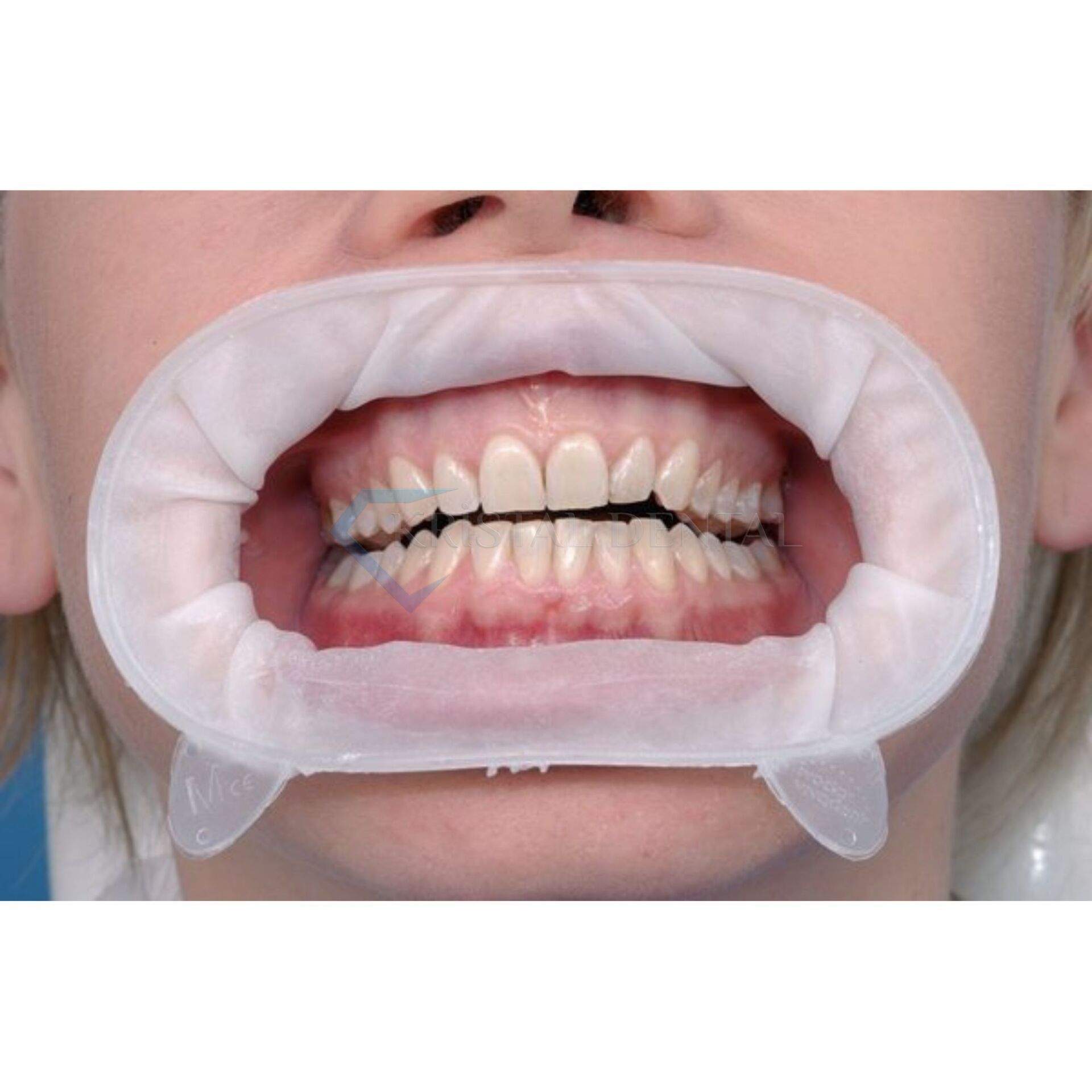 Ivoclar OptraGate Dudak Yanak Ekartörü 40'li