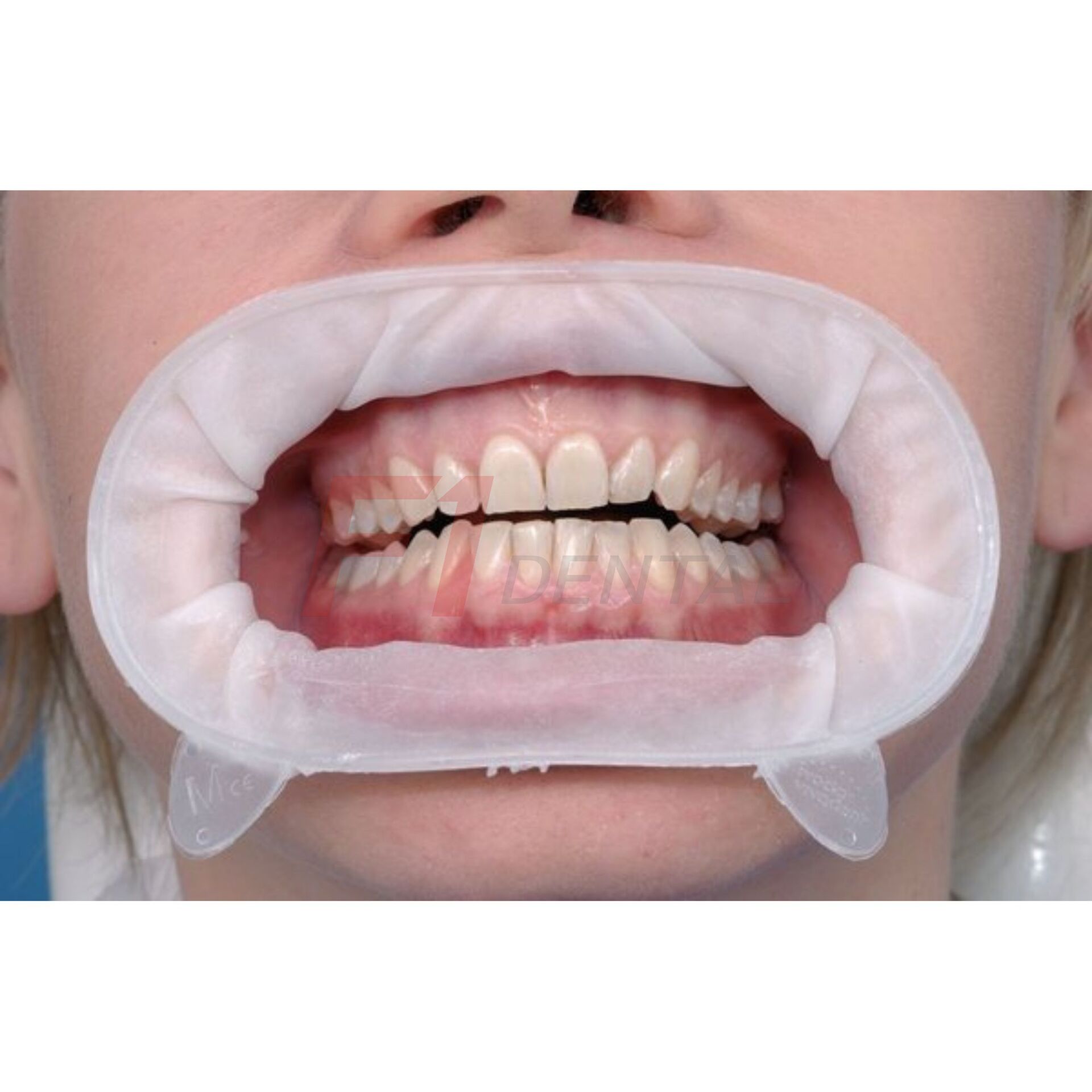 Ivoclar OptraGate Dudak Yanak Ekartörü 40'li