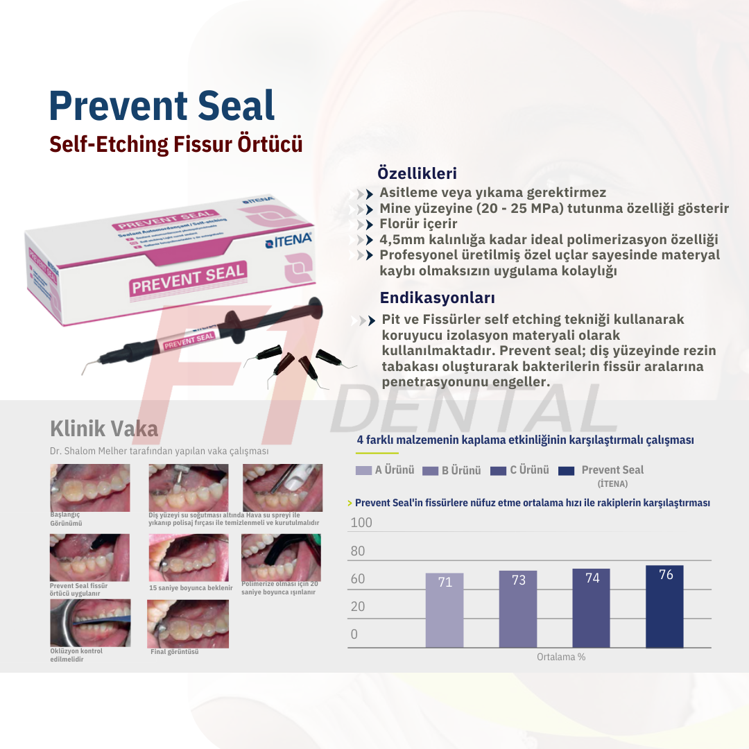 İtena Prevent Seal Fissür Örtücü