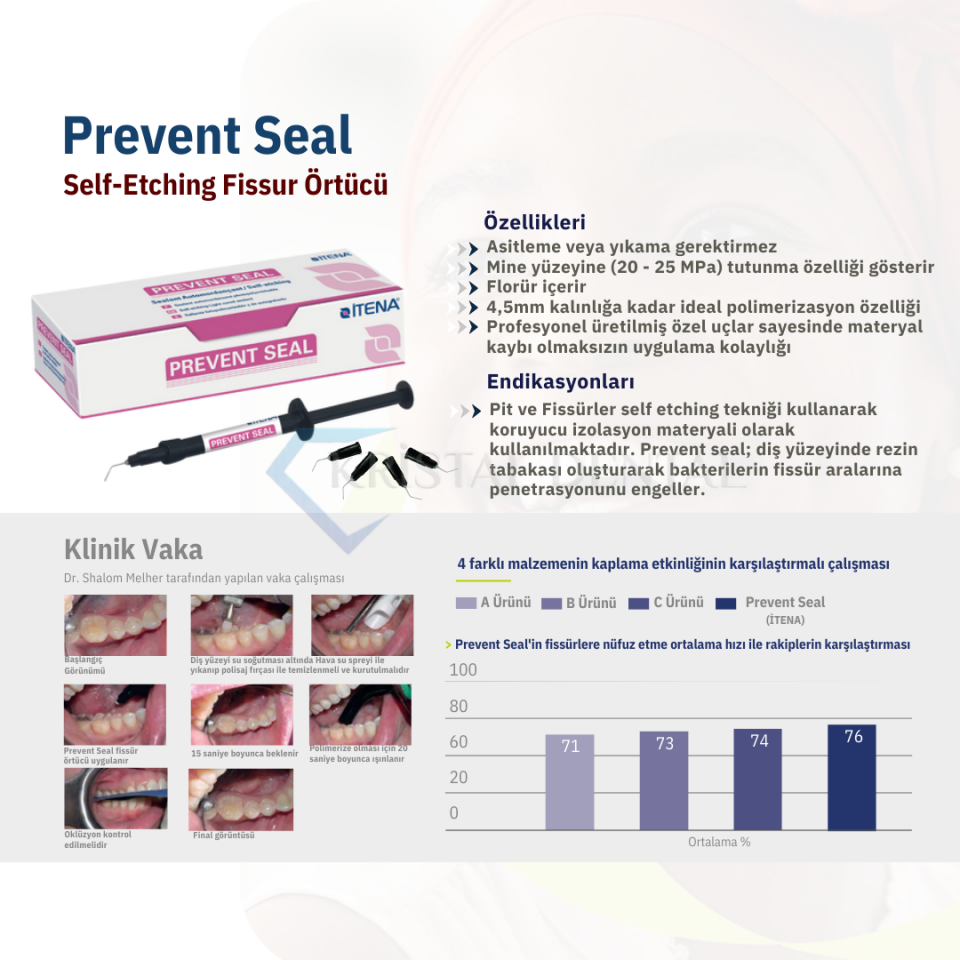 İtena Prevent Seal Fissür Örtücü