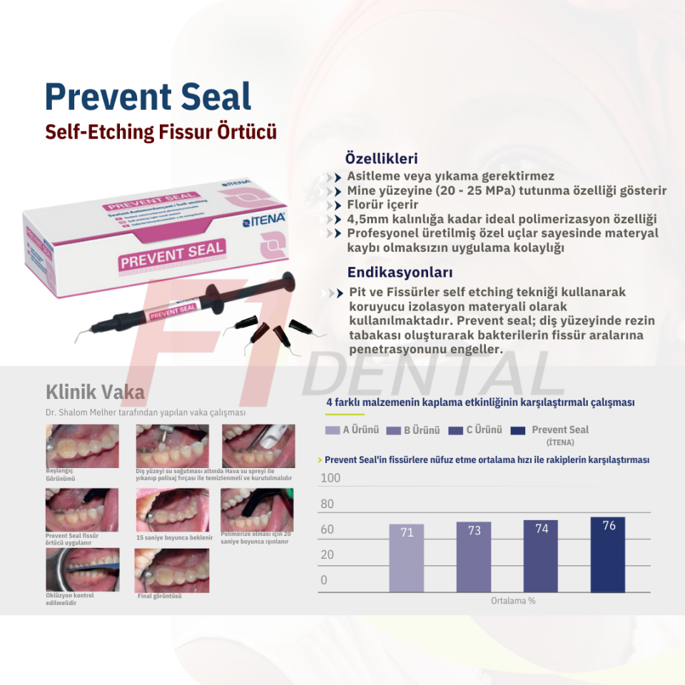 İtena Prevent Seal Fissür Örtücü